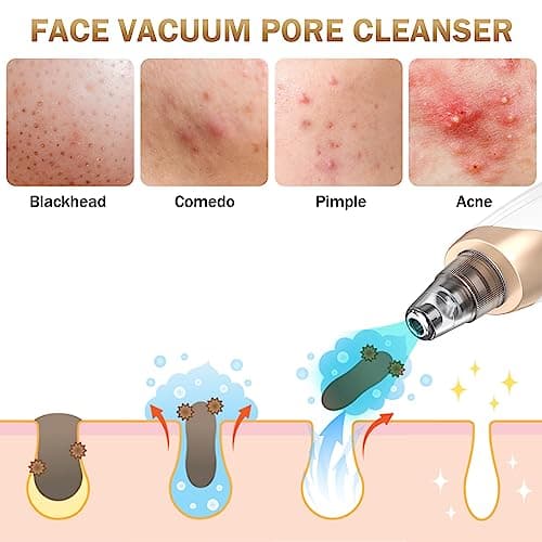 Blackhead Remover Pore Vacuum Kit -Blackhead Extractor Tool with 3 Adjustable Suction Levels, 5 Probes, USB Rechargeable, Suitable for Women and Men(White)