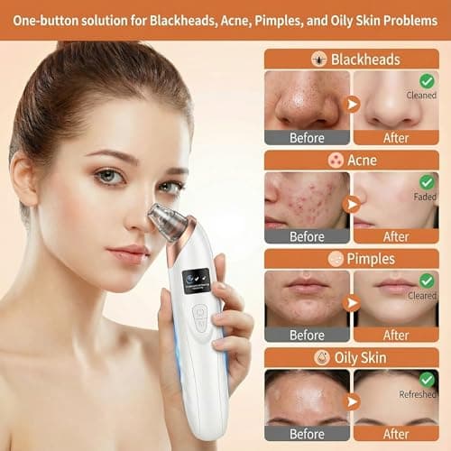 2026 Pore Vacuum, USB Rechargeable Blackhead Remover Vacuum,3 Levels Adjustable Pore Vacuum Blackhead Remover, with 5 Suction Power,6 Probes,Face Vacuum Pore Cleanser for Women & Men-White