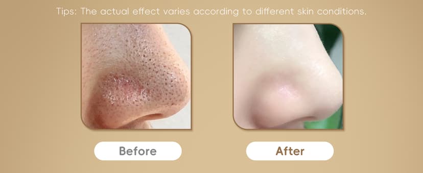 Blackhead Remover Pore Vacuum, Pore Cleaner for Face with 5 Attachments & 3 Suction Levels, USB Rechargeable Facial Blackhead Extractor Tool for Women & Men (Pearl White)