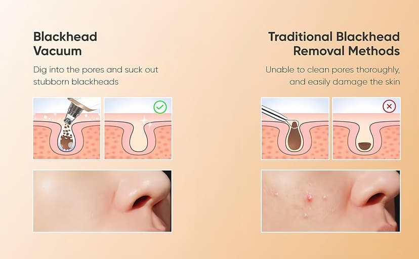 Blackhead Remover Vacuum - Professional Blackhead Extractor for Face with 3 Adjustable Suction Levels, USB Rechargeable Pore Cleaner, and 5 Interchangeable Probes (White)