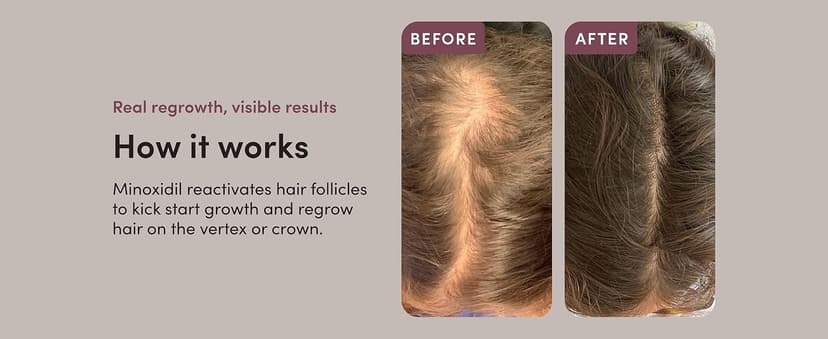 hims Extra Strength Hair Regrowth Treatment for Men with 5% Topical Minoxidil Solution for Hair Loss and Thinning Hair, Unscented, 2 Pack